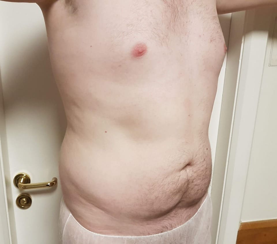 Tummy Tuck Men Before After