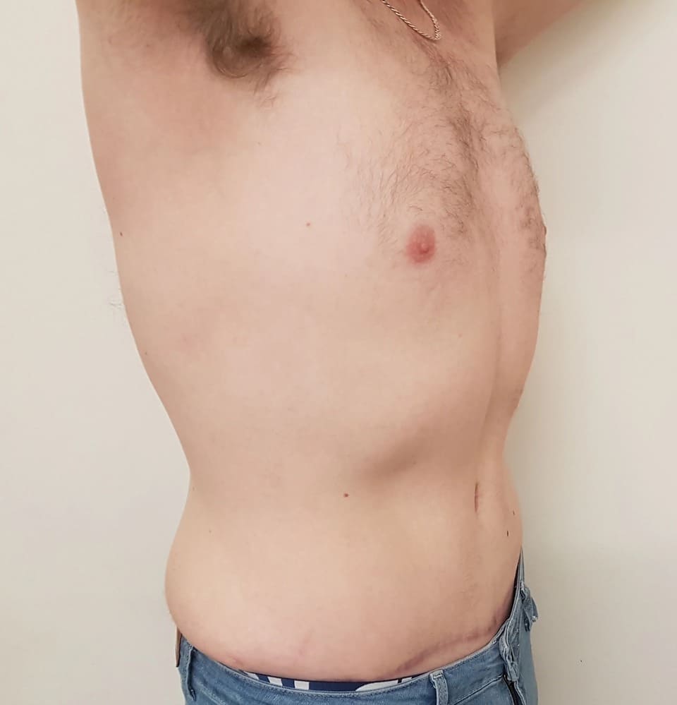 Tummy Tuck Men Before After