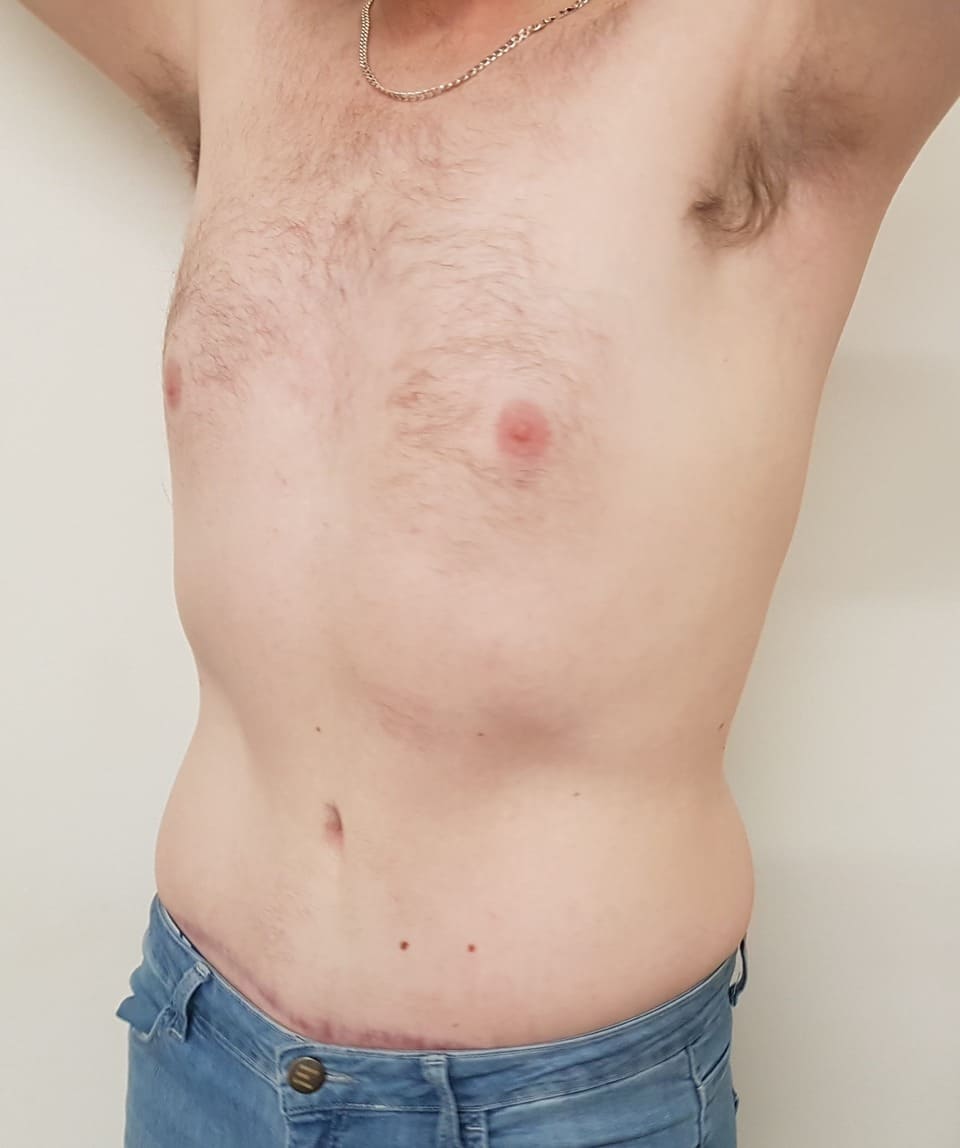 Tummy Tuck Men Before After