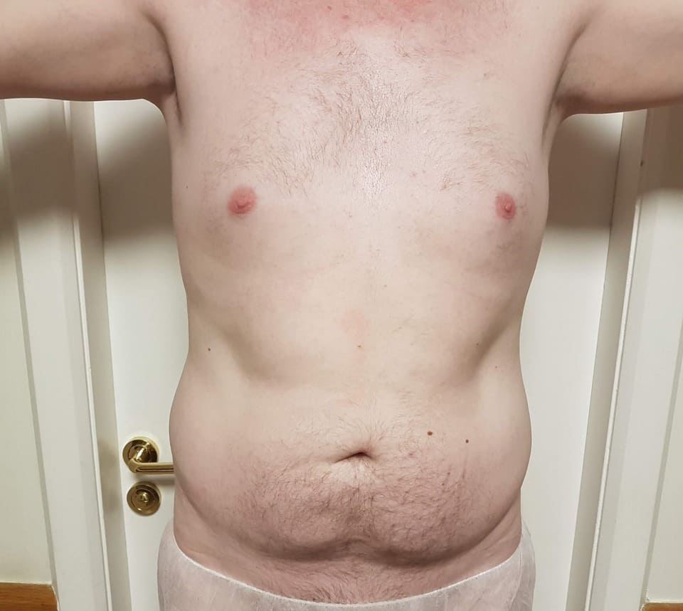 Tummy Tuck Men Before After