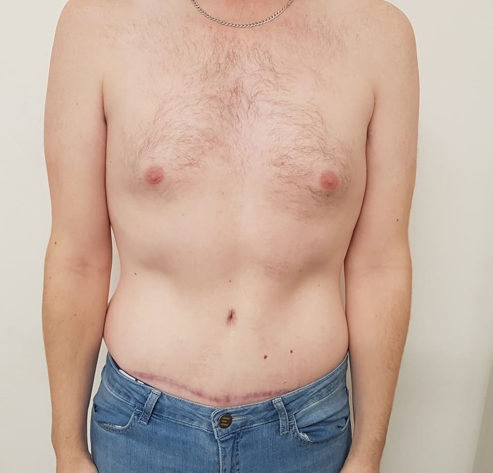 Tummy Tuck Men Before After