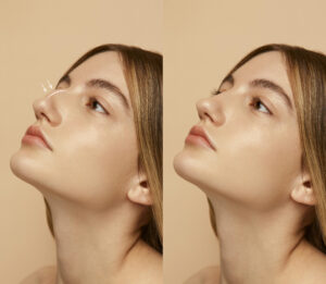Top 5 questions about rhinoplasty answered